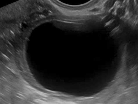 biopsy of ovarian cyst
